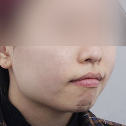 痘痘/疤痕护理 施术后移动端图片 1