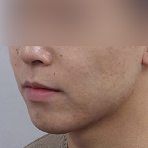 痘痘/疤痕护理 施术后移动端图片 2