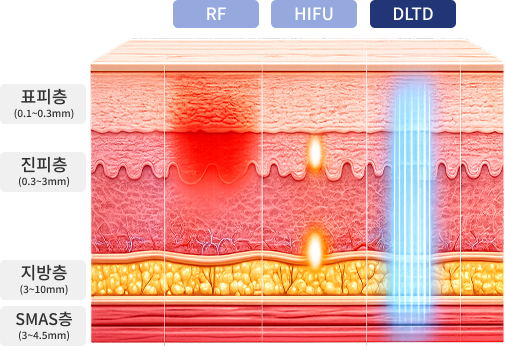 RF, HIFU, DLTD 皮肤层作用靶점对比图