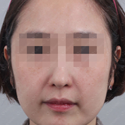 色素美白 施术后 移动端图片 1