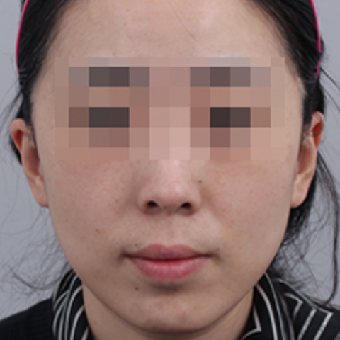 色素美白 施术后 移动端图片 2