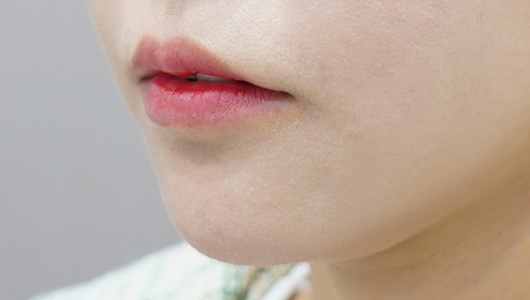 唇部玻尿酸术前（嘴角下垂类型）