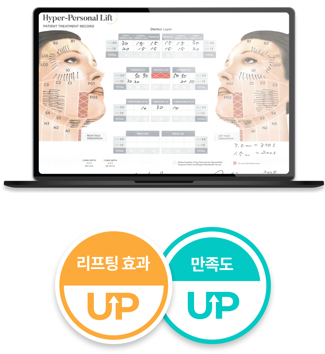 无需担心脸颊凹陷的 Ultherapy Prime 手机端说明图像